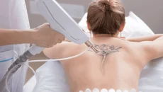 Tattoo Removal